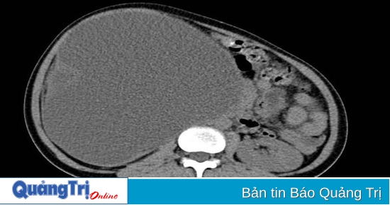 Thực hiện phẫu thuật nội soi cắt thận cho bệnh nhân người Lào