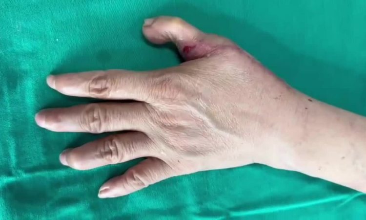 Lấy ngón chân ghép vào ngón tay cho bệnh nhân