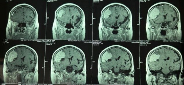 Đau đầu nhiều năm, đi khám bác sĩ khối u màng não to hơn quả trứng - Ảnh 1.