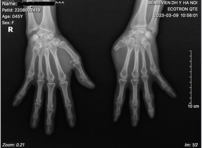 Hình ảnh Xquang bàn tay bệnh nhân trước phẫu thuật. Ảnh: Bác sĩ cung cấp