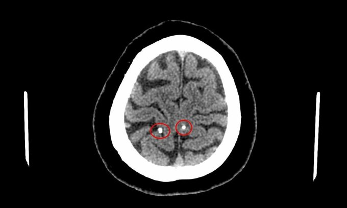 Kết quả chụp phát hiện nang sán ký sinh trong não. Ảnh: Bệnh viện cung cấp