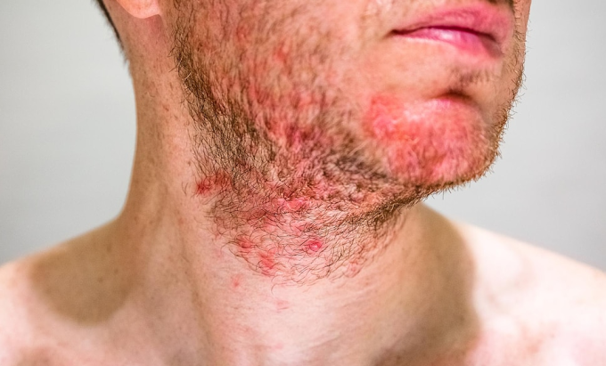 How To Avoid Rash After Shaving Beard