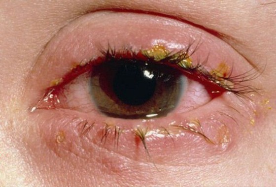Xông, đắp lá cây chữa đau mắt đỏ có thể phải khoét mắt ảnh 2