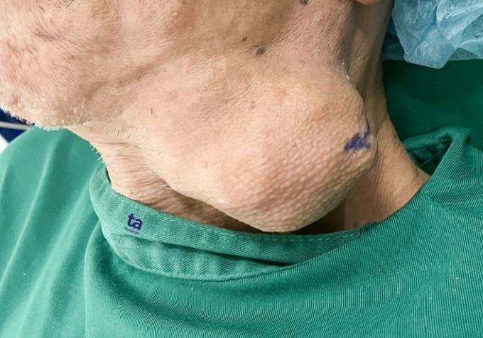 U dưới hàm bệnh nhân, kích thước 12 cm. Ảnh: Nguyễn Trăm