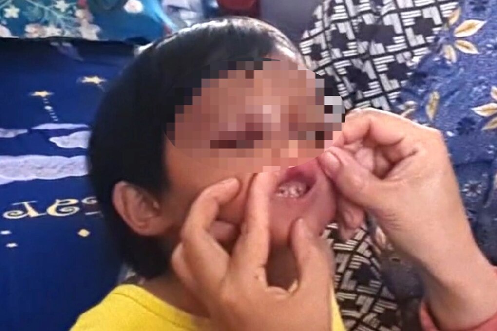 Vụ bé gái 4 tuổi nghi bị cha nuôi bạo hành: Đánh con bằng chổi cán nhựa - 1