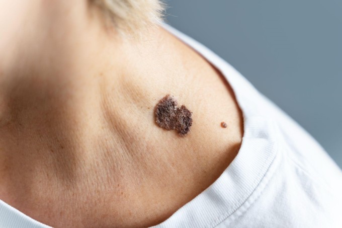 Nốt ruồi bất thường hay vết đốm, nổi sần trên da có thể là dấu hiệu ung thư. Ảnh: Freepik