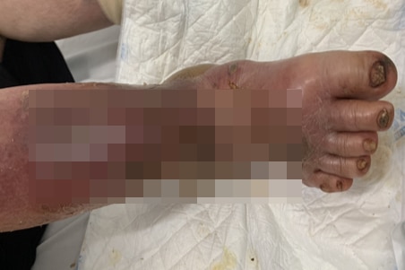 Lạm dụng corticoid liều cao, bàn chân của một nữ bệnh nhân 58 tuổi (ngụ Thái Nguyên) bị sưng vù, da rất mỏng, gây rách da, nhiễm trùng nặng... - Ảnh: Bệnh viện cung cấp 
