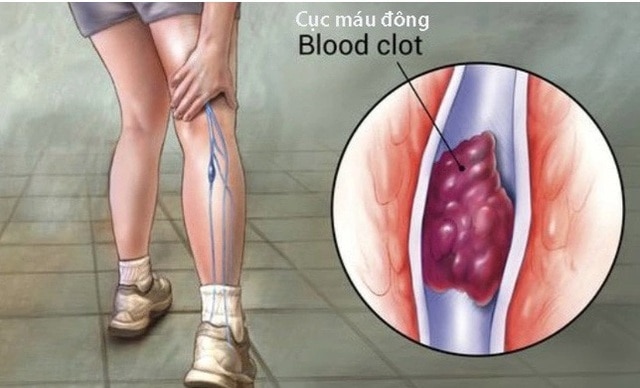 Bất ngờ 6 thực phẩm rẻ tiền làm tan cục máu đông, người Việt nên ăn để phòng đột quỵ- Ảnh 3.