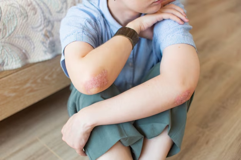 Các bệnh lý da liễu cũng là nguyên nhân khiến da trẻ bị khô, ngứa, sưng đỏ