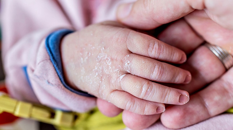 Vốn dĩ làn da trẻ em mỏng manh, nhạy cảm nên rất dễ bị khô và bong tróc