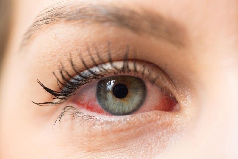 Viêm kết mạc khiến mắt bệnh nhân bị đỏ