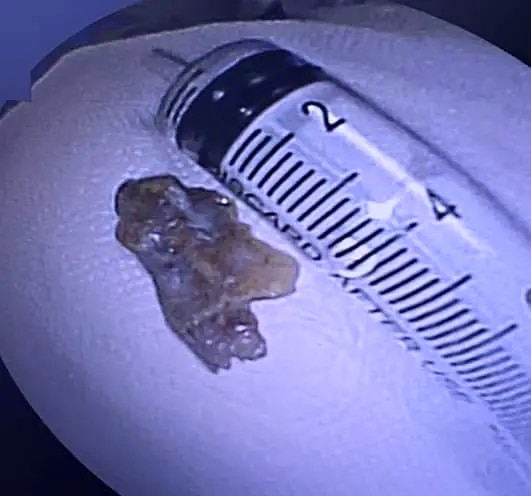 Dị vật là mảnh xương có kích thước 1,5x2,5cm được lấy ra khỏi phế quản bệnh nhân Đ.