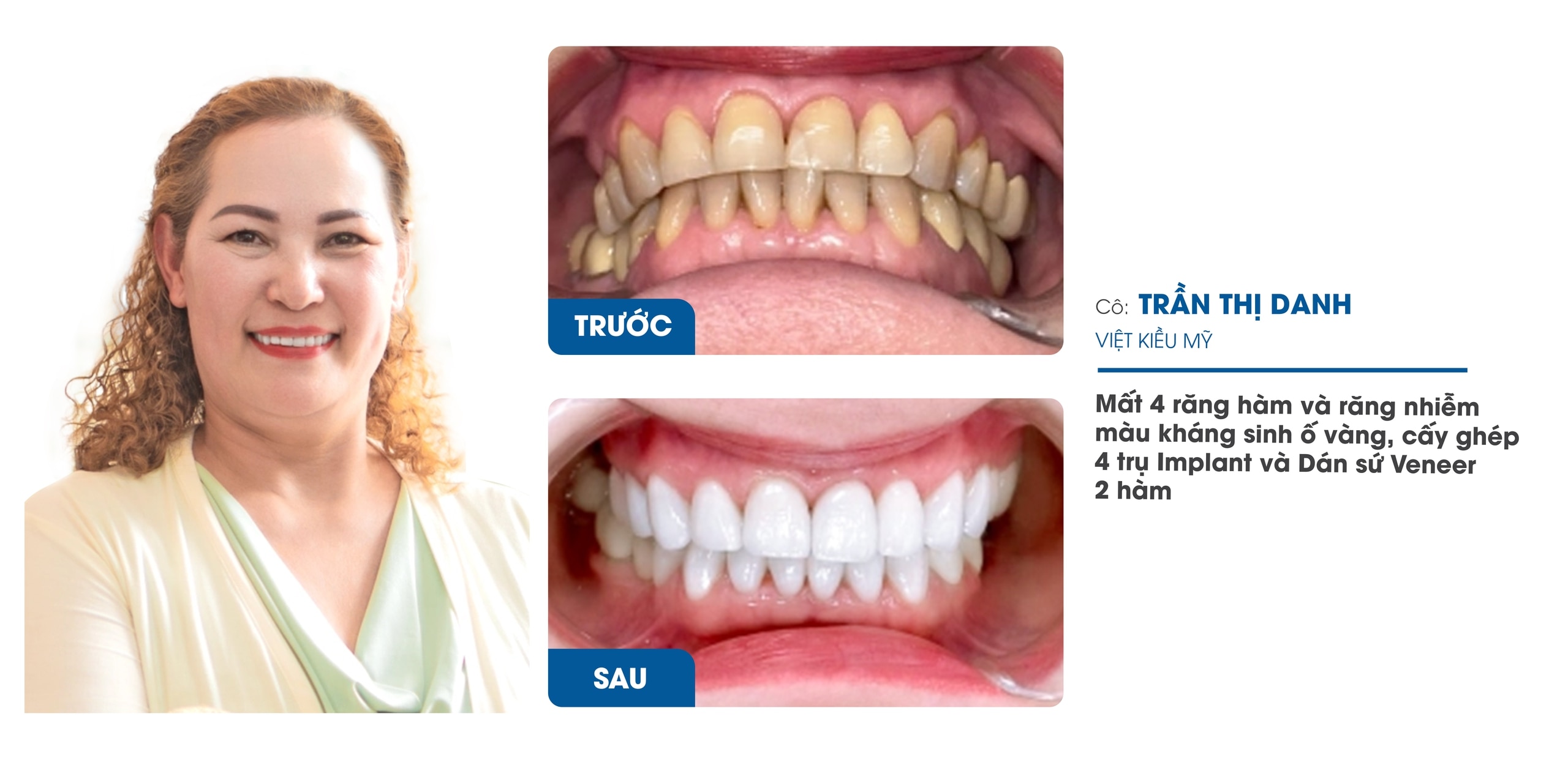 Nha Khoa Răng Sứ I-Dent Diamondtech ứng dụng công nghệ Digital Smile Design trong thiết kế nụ cười- Ảnh 3.