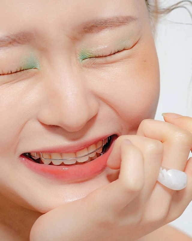 Chăm sóc hàm duy trì sau khi niềng răng hiệu quả nhất từ nha sĩ- Ảnh 2.