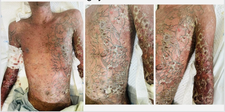 Hành trình hơn 6 tháng cứu bệnh nhân mắc bệnh hiếm lần đầu được báo cáo tại Việt Nam ảnh 2