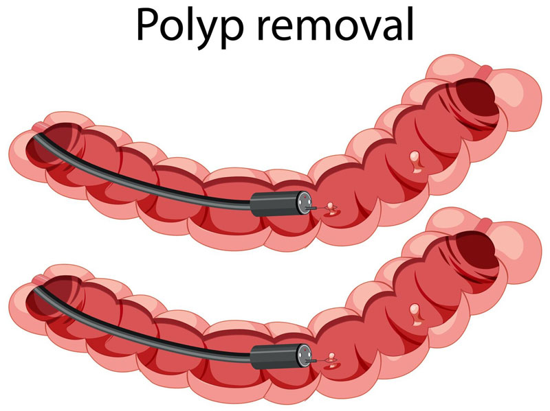 Phẫu thuật nội soi cắt Polyp trực tràng có thể điều trị bệnh