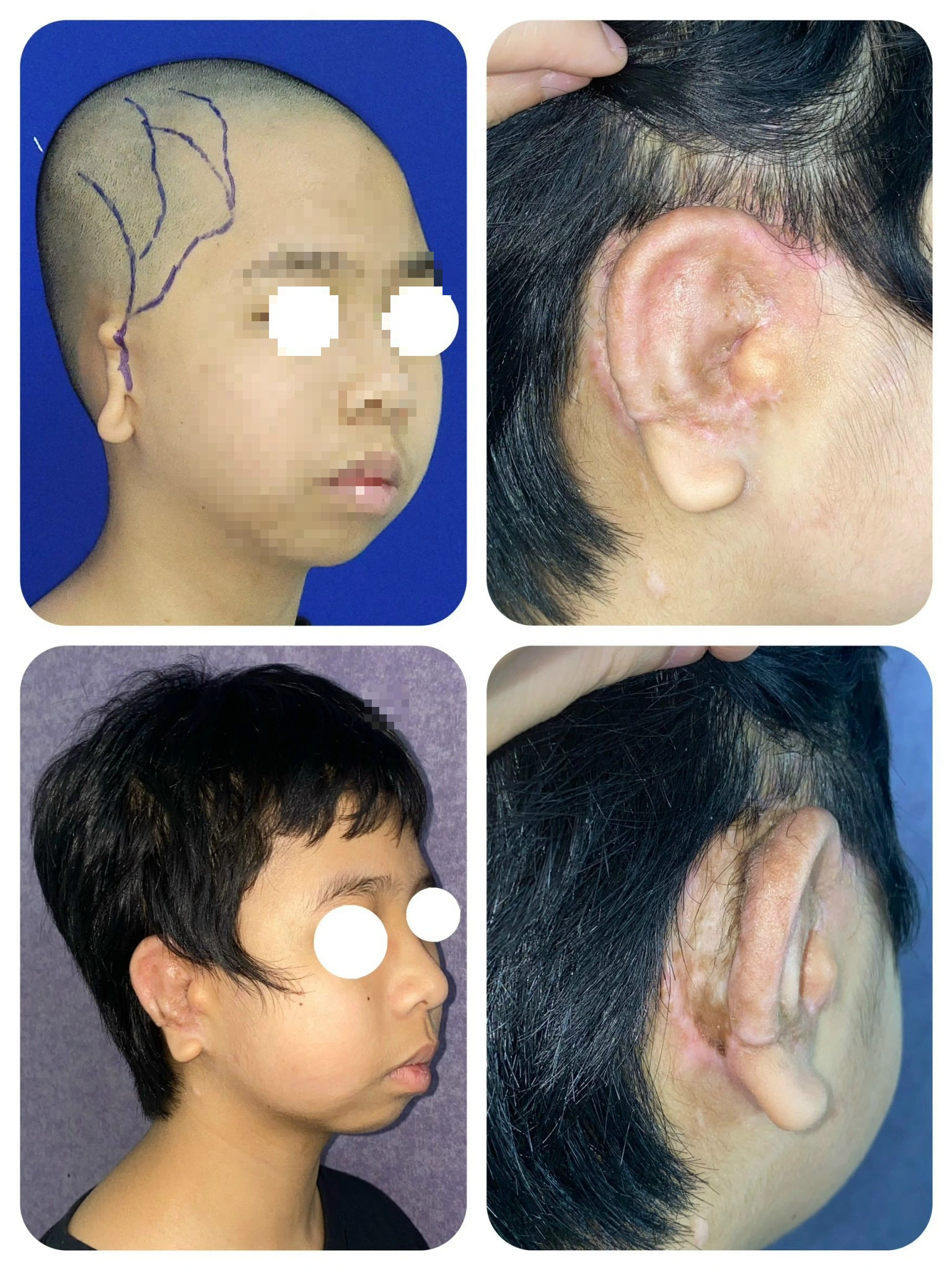 Bé trai lép nửa mặt, dị tật tai nhỏ được phẫu thuật thành công- Ảnh 1.