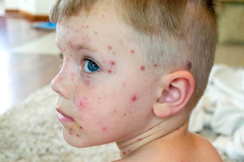 Varicella Zoster là loại virus gây bệnh thủy đậu