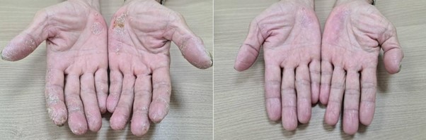Mang bệnh do tiếp xúc với chất tẩy rửa bằng tay không- Ảnh 1.