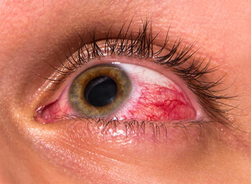 Mắt nổi gân đỏ thường do viêm kết mạc hoặc xuất huyết dưới kết mạc
