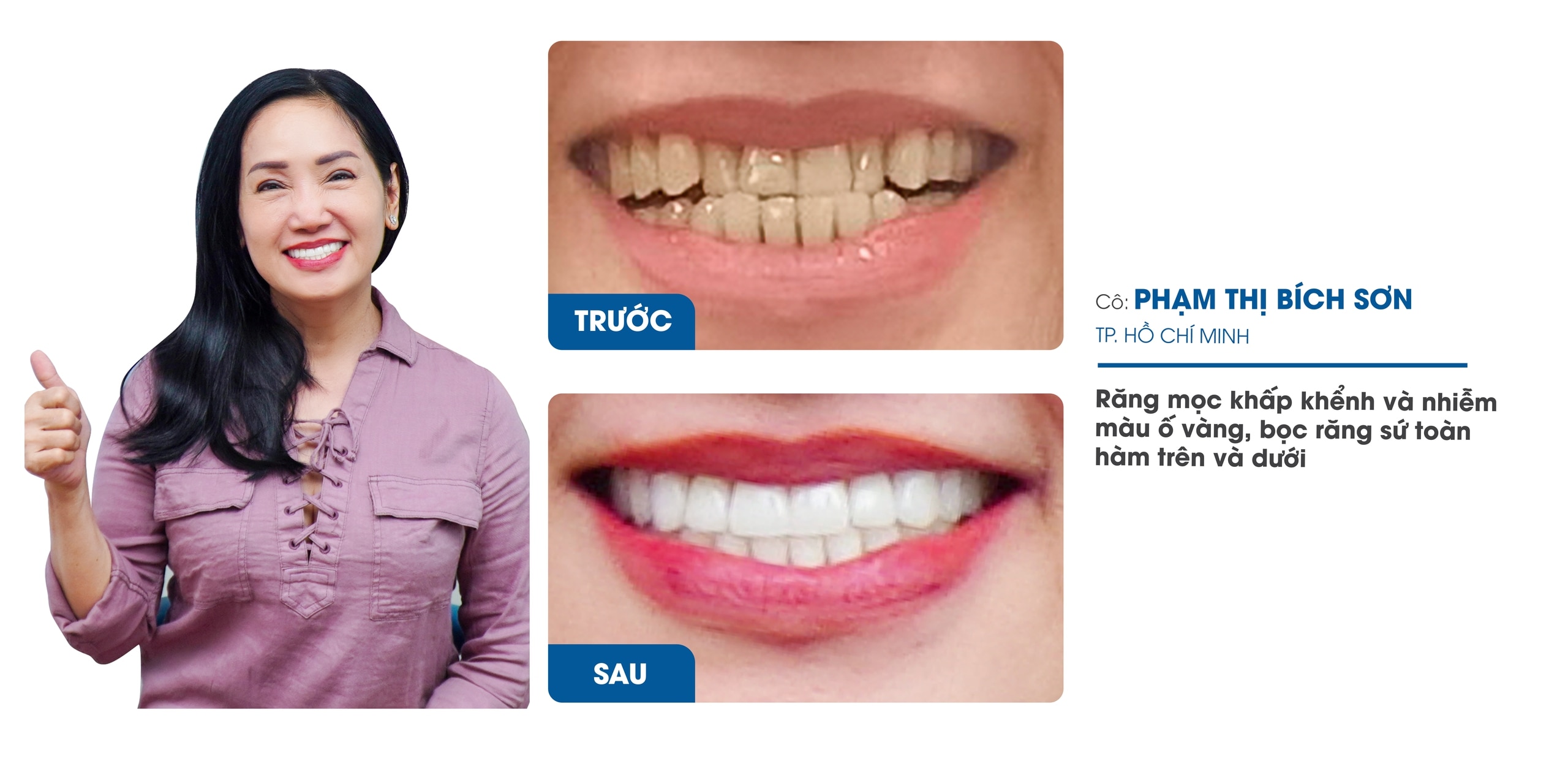 Nha Khoa Răng Sứ I-Dent Diamondtech ứng dụng công nghệ Digital Smile Design trong thiết kế nụ cười- Ảnh 2.