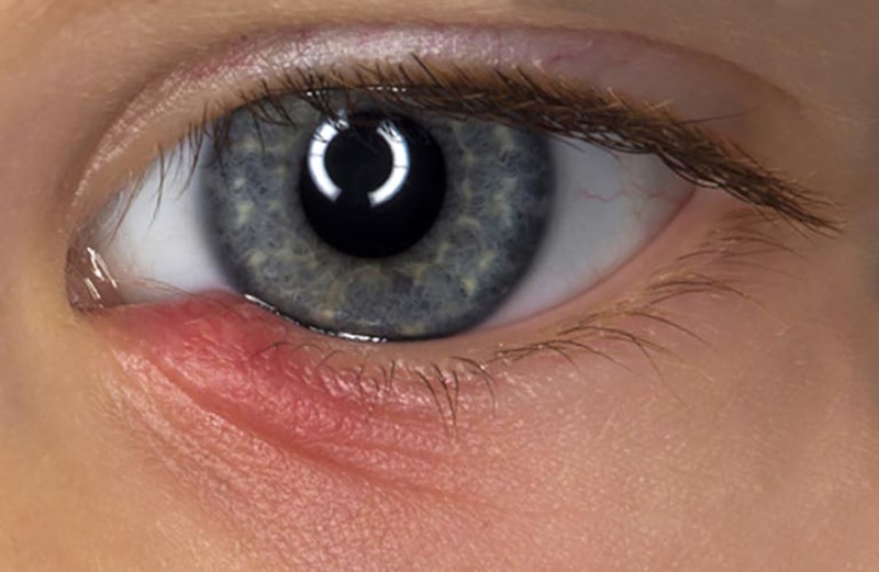 Có nhiều nguyên nhân gây tắc tuyến lệ như viêm mắt, tai nạn, chấn thương,…
