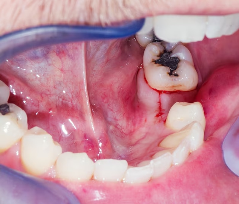 Ung thư răng với những triệu chứng ban đầu giống với viêm nướu răng