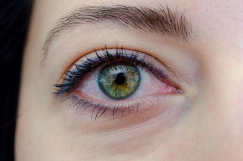 Đau mắt đỏ 1 bên có thể do vi khuẩn