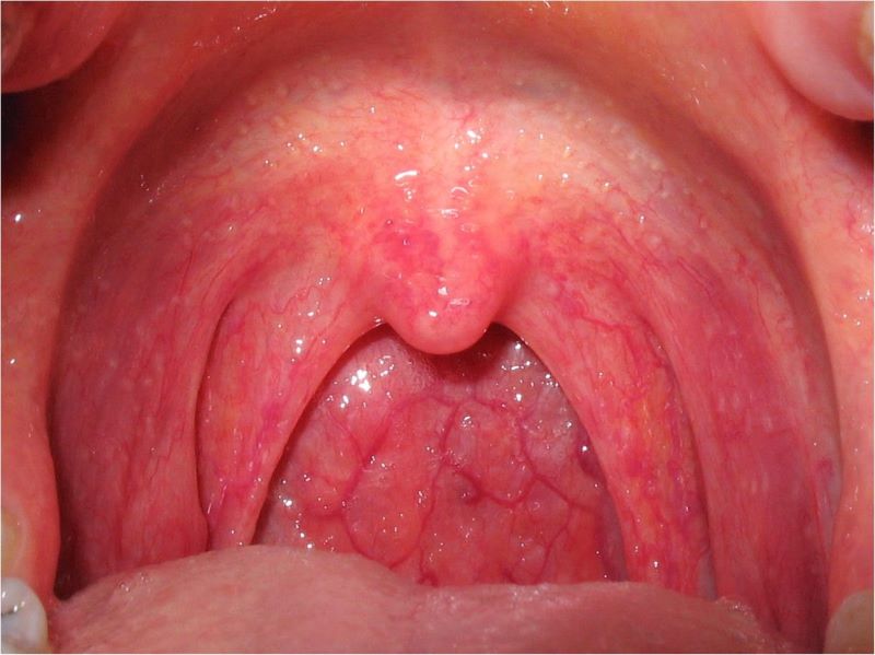 Nổi hạt trong họng có thể là dấu hiệu cảnh báo bệnh lý nguy hiểm