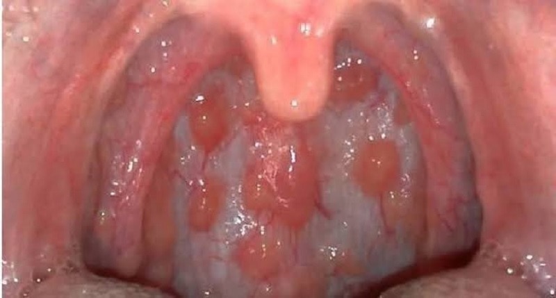 Hình ảnh cho thấy viêm họng hạt ở trẻ